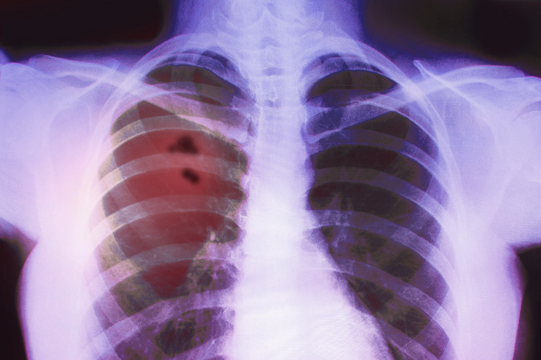 Röntgenbild der Lunge mit erkennbarer Lungenkrankheit